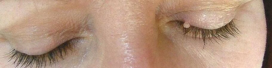 Papilloma on the eyelid