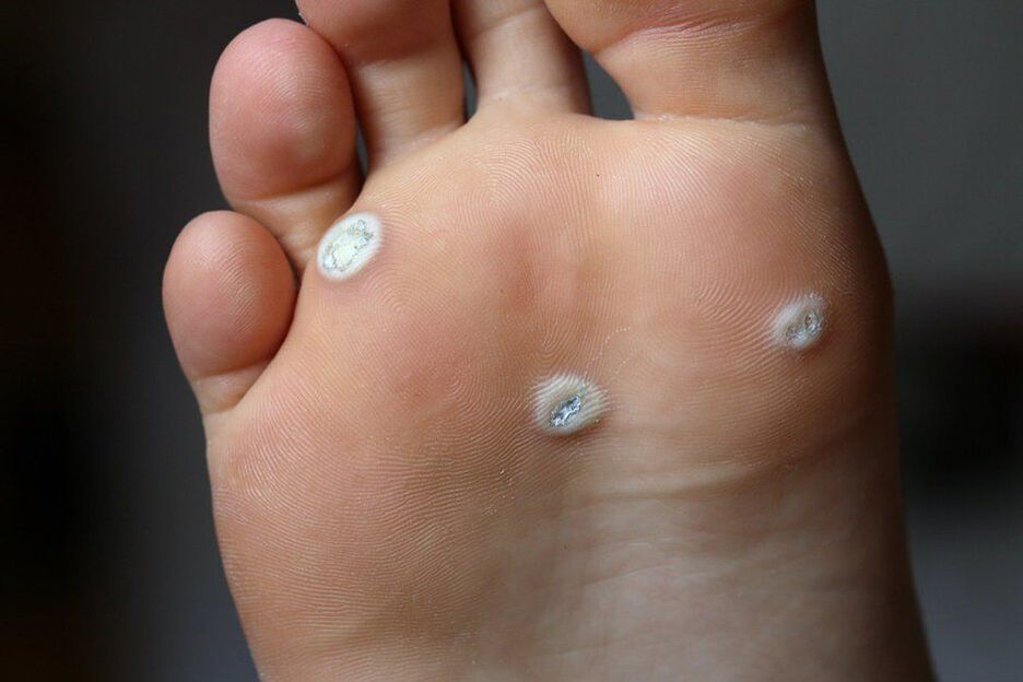 Plantar warts