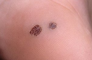 warts on the palm of your hand