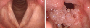 Papilloma in the mouth